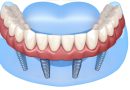 ปลดล็อกปัญหาฟัน เติมเต็มความมั่นใจให้กับผู้สูงวัย ด้วยรากฟันเทียม All-on-4 
